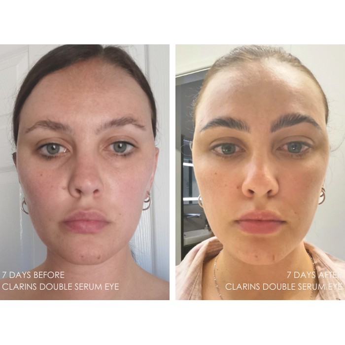 قبل و بعد استفاده از دور چشم کلارنس