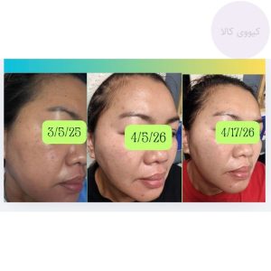 نتایج استفاده از کرم بازسازی فعال Centellian24 Expert Madeca PDRN